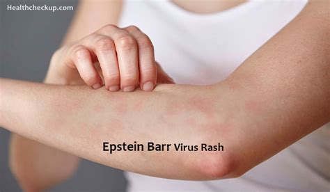 epstein barr virus symptome